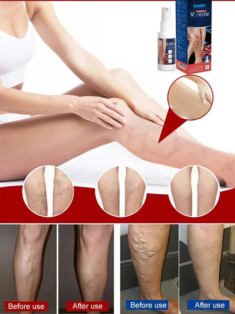 Varicose Vein Treatment Spray (Health Care Spray)