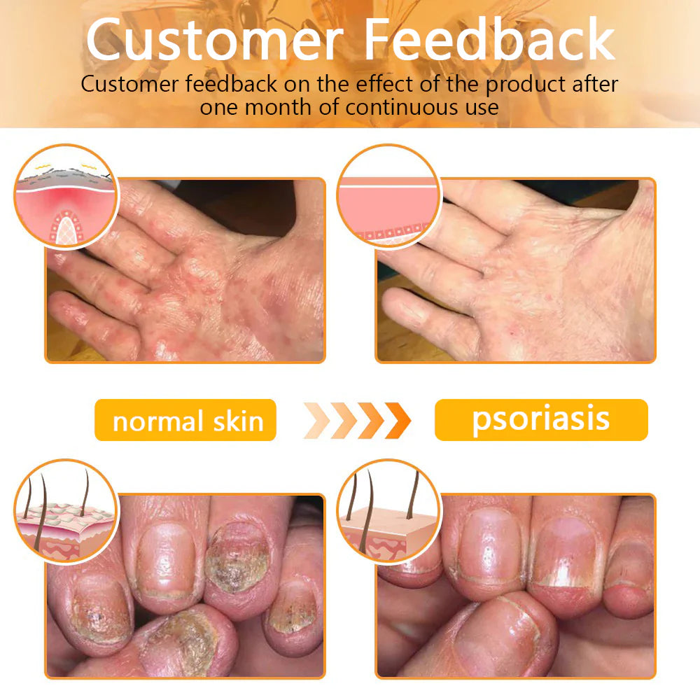 【Made in USA】𝑇𝑢𝑟𝑜𝑛𝑢™ Bee Venom Skin Treatment Cream