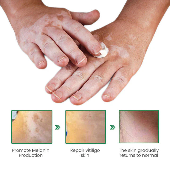 Fivfivgo™ White Spot Repair Cream
