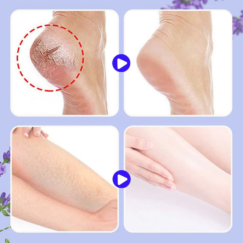 🔥Sold over 100 000❤️Nourishing and repairing foot cream for cracks🎁50% off limited time benefits
