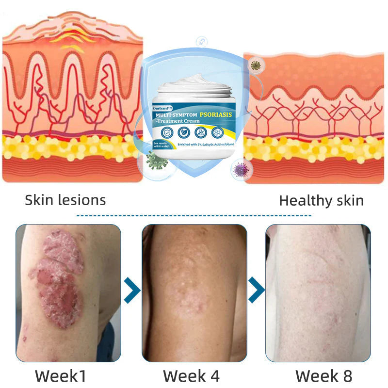 Ourlyard™ Multi-Symptom Psoriasis Treatment Cream(👨⚕Doctor's Recommendation)✨✨✨✨