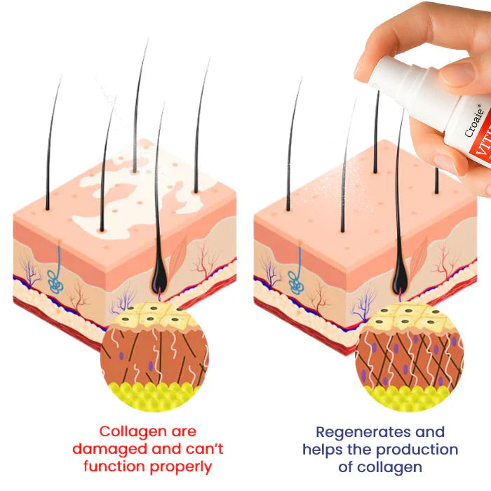 FDA Approved WHO Approved Croaie® Vitiligo Treatment Sparay-No allergies Quick and effective With over 150000 sold!