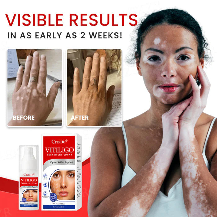 FDA Approved WHO Approved Croaie® Vitiligo Treatment Sparay-No allergies Quick and effective With over 150000 sold!