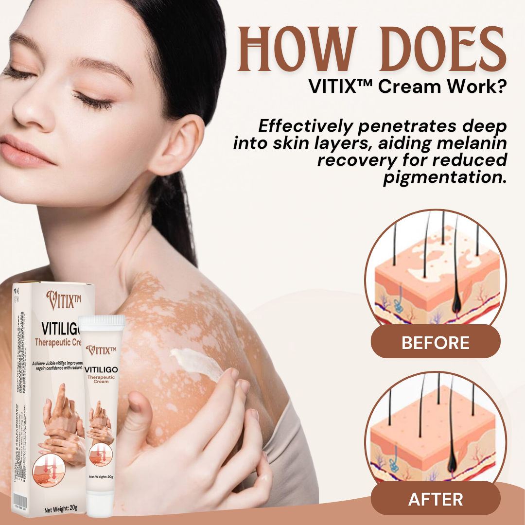 VITIX™ Vitiligo Therapeutic Cream - Sale at 80% discounts today!