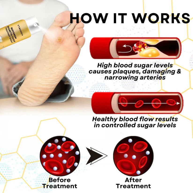 ⏰Last Day Promotion: 60% OFF 🔥CVREOZ® Bee Venom Diabetic Foot Treatment Spray