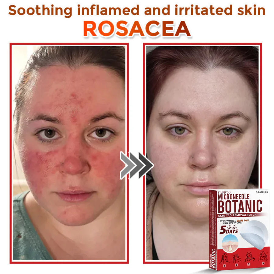 Fivfivgo® MicroNeedle Botanic Skin Tag Removal Patch