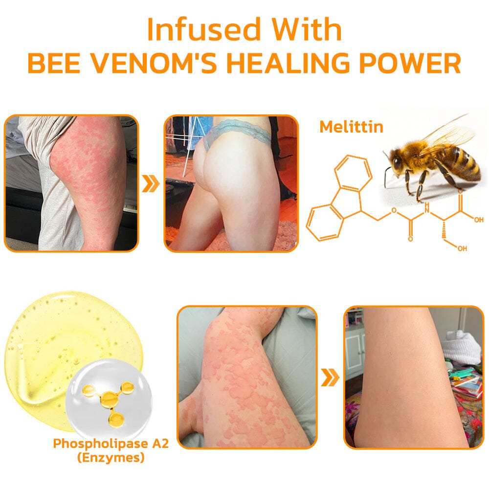 Furzero™ Urticaria Bee Venom Therapy Cream