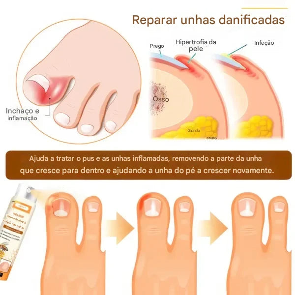 Limited-time sale until 2025🎁 with 70% off⏳ on Ceoerty® nail fungus spray with bee venom 💥 solves all nail problems in 2 weeks