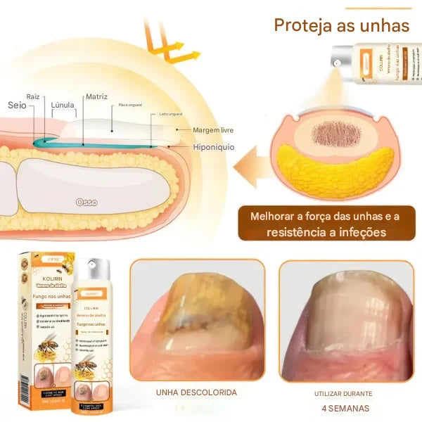 Limited-time sale until 2025🎁 with 70% off⏳ on Ceoerty® nail fungus spray with bee venom 💥 solves all nail problems in 2 weeks