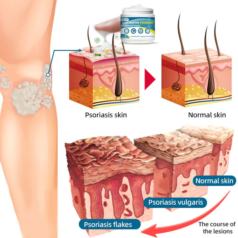 Ourlyard™ Multi-Symptom Psoriasis Treatment Cream（👨‍⚕Doctor's Recommendation）✨✨✨✨