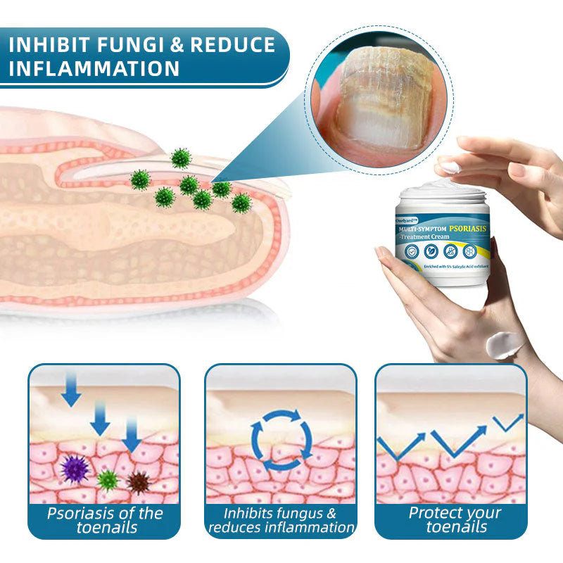 Ourlyard™ Multi-Symptom Psoriasis Treatment Cream（👨‍⚕Doctor's Recommendation）✨✨✨✨