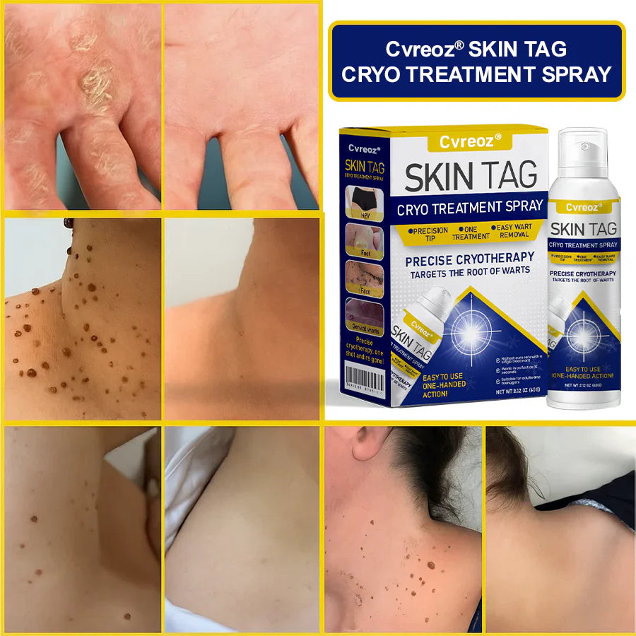 ⏰Last Day Promotion: 60% OFF🔥 Cvreoz® Skin Tag Cryo Treatment Spray