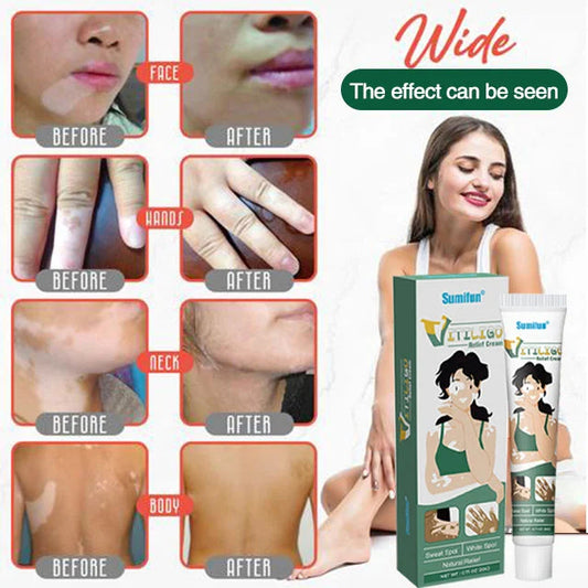 Vitiligo Treatment Ointment